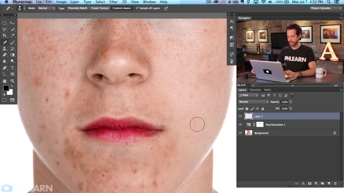 Multiple blemishes healed, before-and-after visible across the cheek area